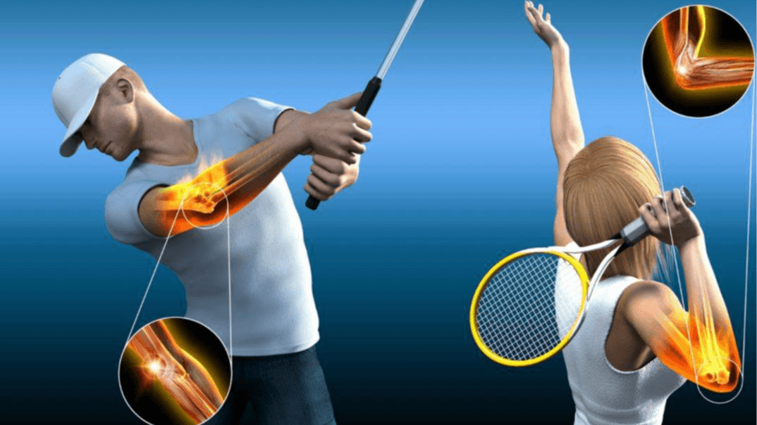 Treatment for tennis/golfer’s elbow - Healthcare service image