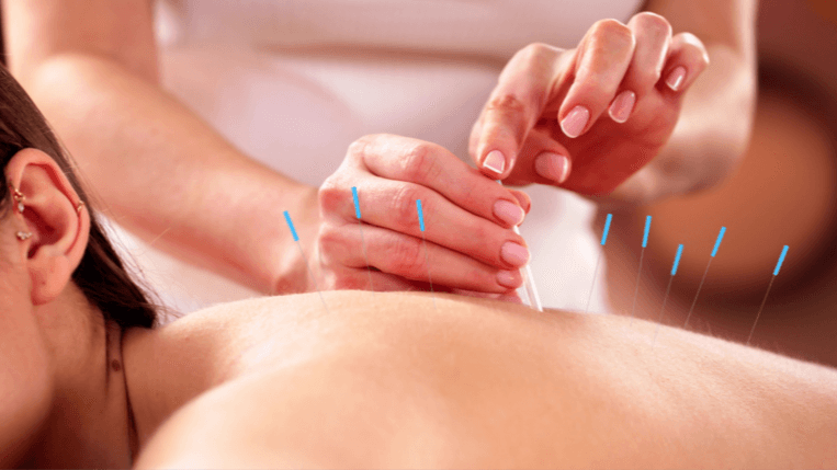 الوخز بالإبر الجافة - Healthcare service image