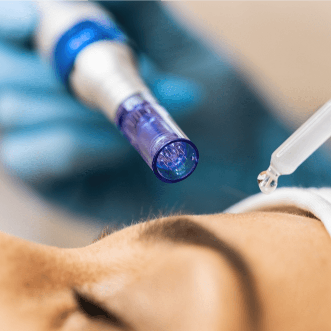 Microneedling - Healthcare service image