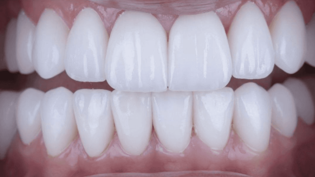 Veneers (Hollywood Smile)  - Healthcare service image