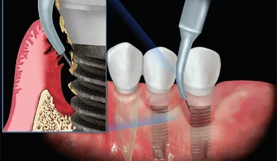  
تركيب الزرعات والزيركون - Healthcare service image