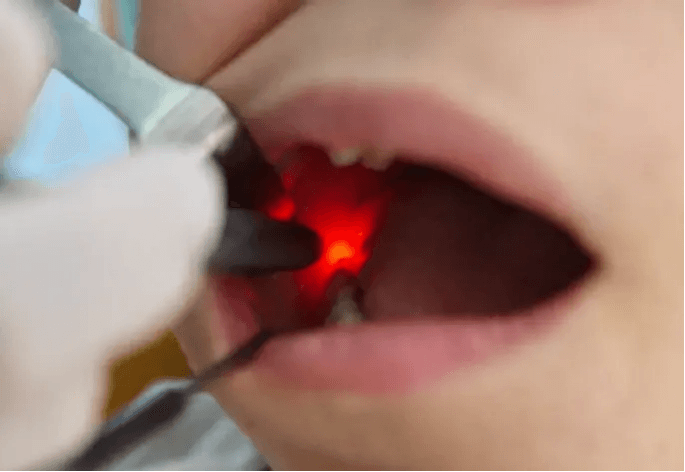  
تركيب الأسنان (الزركونيوم) - Healthcare service image