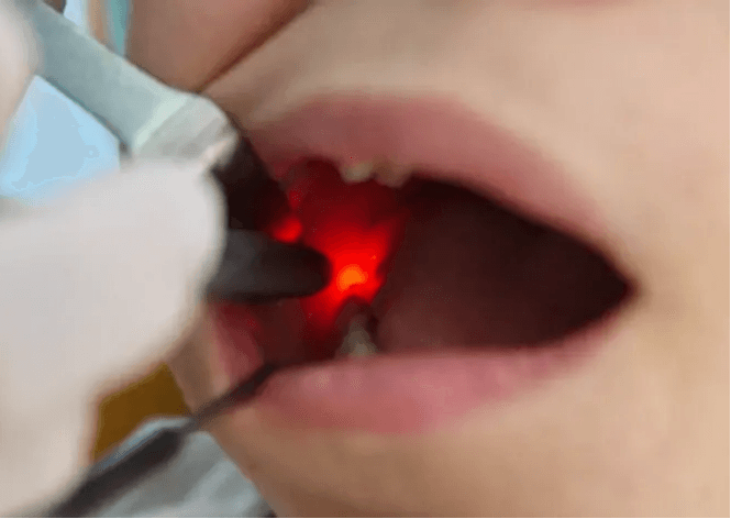  
تكلفة الحشوة البصرية للسن الواحد - Healthcare service image