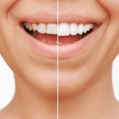 Veneers [Cost Range Between AED 5,000-AED 15,000] - Healthcare service image