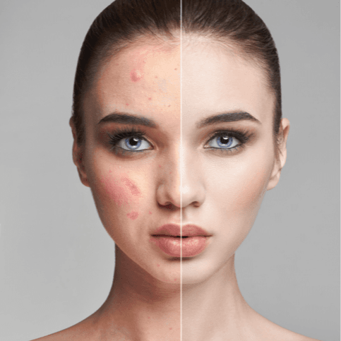 DNA Test: Acne Profile - Healthcare service image