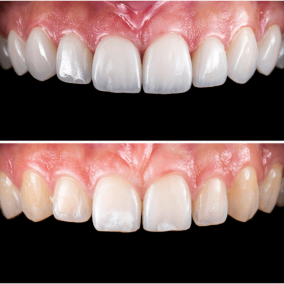  
Emax Veneer - Healthcare service image