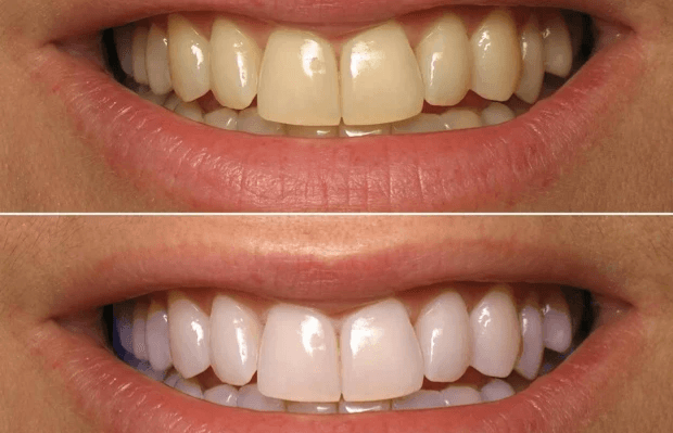  
تنظيف الأسنان العميق - Healthcare service image