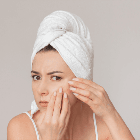  
Acne TCA Peel - Healthcare service image